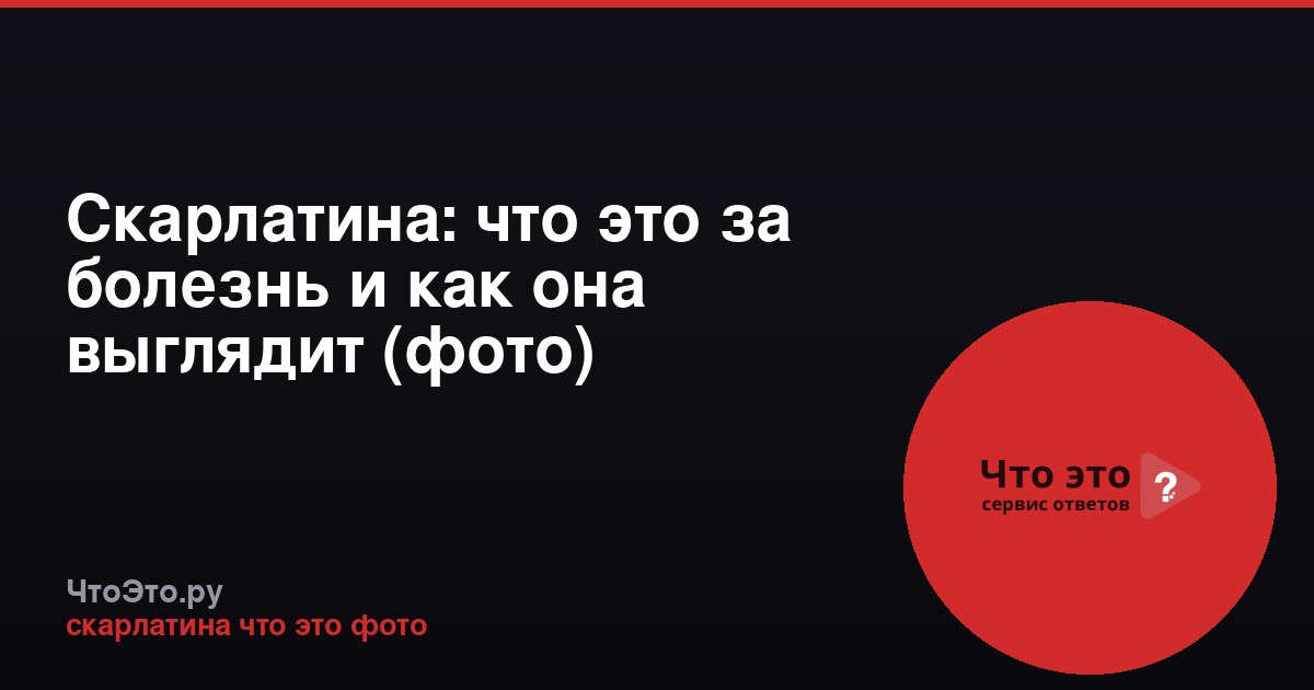Скарлатина: что это за болезнь и как она выглядит (фото)